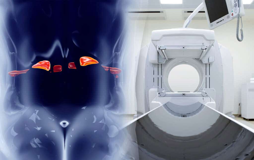 nebennierenszintigraphie