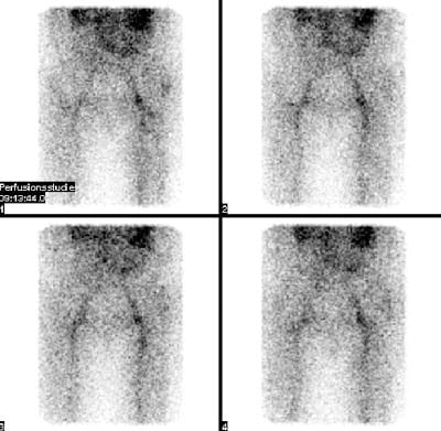 Hüftkopfnekrose bei 64-jähriger Frau unter hochdosierter Kortikosteroidmedikation wegen Polymyalgia rheumatica seit 6 Wochen. Typisch sind die Mehrperfusion und der vermehrte Knochenumbau im rechten Hüftkopf bis in das Trochanterenmassiv mit Aussparung eines runden Defekts im Hüftkopfzentrum.