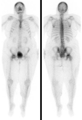 Hüftkopfnekrose bei 64-jähriger Frau unter hochdosierter Kortikosteroidmedikation wegen Polymyalgia rheumatica seit 6 Wochen. Typisch sind die Mehrperfusion und der vermehrte Knochenumbau im rechten Hüftkopf bis in das Trochanterenmassiv mit Aussparung eines runden Defekts im Hüftkopfzentrum.