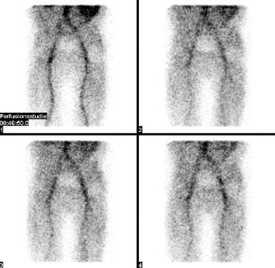 Transiente Osteoporose (Vorstufe einer Hüftkopfnekrose, die durch Entlastung häufig noch verhindert werden kann) bei einem 73-jährigen Mann. Die geringe Mehrdurchblutung sowie der stark vermehrte Knochenumbau im gesamten rechten Hüftkopf einschließlich Schenkelhals und Trochanterenmassiv sprechen stark für das Vorliegen einer transienten Osteoporose. Eine Hüftkopfnekrose scheint noch nicht vorzuliegen (in diesem Fall wäre eine kugelförmige Aussparungen im rechten Hüftkopf zu erwarten, s.o.). Für eine akute Osteomyelitis ist das Ausmaß der Mehrdurchblutung zu gering.