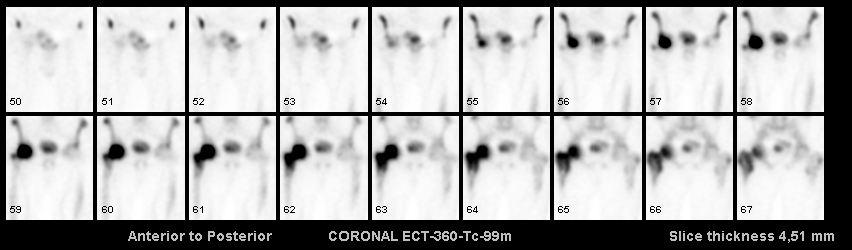 Transiente Osteoporose (Vorstufe einer Hüftkopfnekrose, die durch Entlastung häufig noch verhindert werden kann) bei einem 73-jährigen Mann. Die geringe Mehrdurchblutung sowie der stark vermehrte Knochenumbau im gesamten rechten Hüftkopf einschließlich Schenkelhals und Trochanterenmassiv sprechen stark für das Vorliegen einer transienten Osteoporose. Eine Hüftkopfnekrose scheint noch nicht vorzuliegen (in diesem Fall wäre eine kugelförmige Aussparungen im rechten Hüftkopf zu erwarten, s.o.). Für eine akute Osteomyelitis ist das Ausmaß der Mehrdurchblutung zu gering.