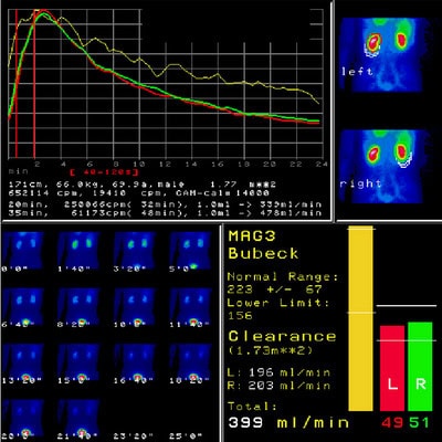 Normale Nierenfunktionsszintigraphie bei einem 69-jährigen Mann.