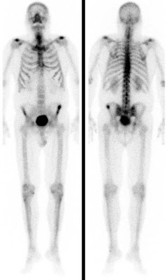 Skelettmetastase im linken Darmbein bei Erstdiagnose eines Prostata-Carcinoms (74 J.).