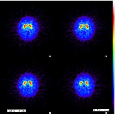 Normaler DaTScan mit kommaförmiger Darstellung der Striati (= Nn. caudati + Putamina). Der Befund spricht gegen einen M. Parkinson oder ein Parkinson-Syndrom.