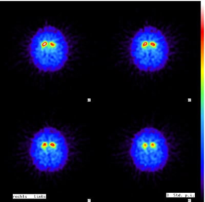 Pathologischer DaTScan mit verminderter Darstellung beider Putamina (nur noch Punkte, keine Kommas mehr). Der Befund spricht für einen M. Parkinson oder ein Parkinson-Syndrom, z.B. eine Multisystematrophie.