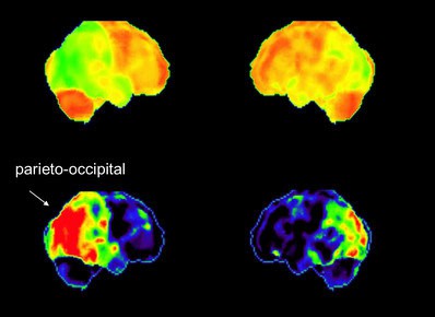 Hirnperfusionsszintigraphie mit CED bei einer Patientin mit einer Alzheimer-Demenz.